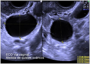 Ecografía Ginecológica