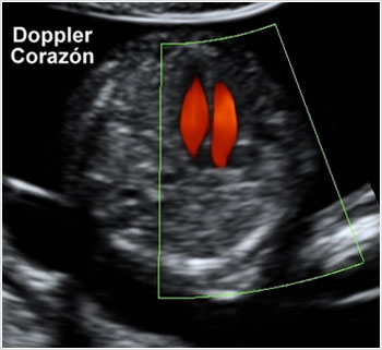 Ecografía Obstétrica