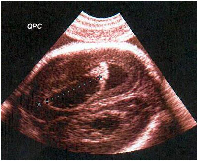 Ecografía Obstétrica