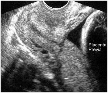 Ecografía Obstétrica