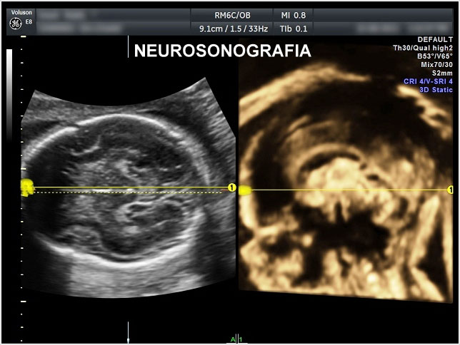 Ecografía Obstétrica